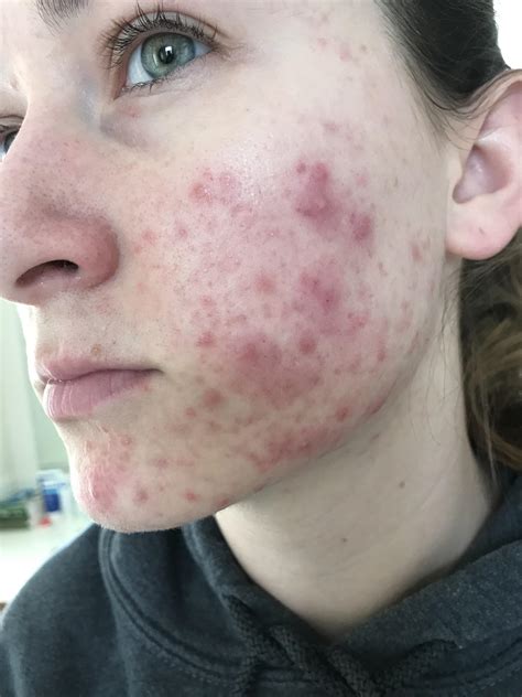 You won't know until you try it but <b>Yaz</b> isn't meant for <b>acne</b> treatment really. . Yaz acne worse before better reddit